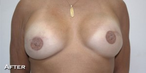 Breast Reconstruction after Mastectomy