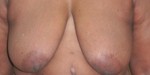 Breast Reconstruction after Mastectomy