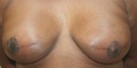 Breast Reconstruction after Mastectomy