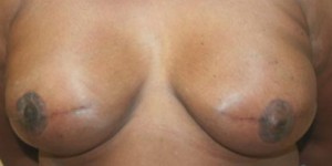 Breast Reconstruction after Mastectomy