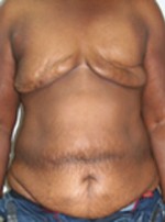 Breast Reconstruction after Mastectomy