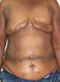 Breast Reconstruction after Mastectomy