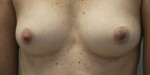 Breast Reconstruction after Mastectomy