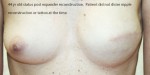 Breast Reconstruction after Mastectomy