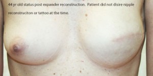 Breast Reconstruction after Mastectomy