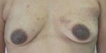 Breast Reconstruction after Mastectomy