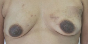 Breast Reconstruction after Mastectomy