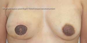 Breast Reconstruction after Mastectomy