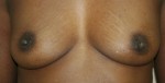 Breast Reconstruction after Mastectomy