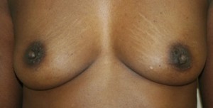 Breast Reconstruction after Mastectomy