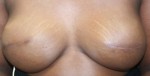 Breast Reconstruction after Mastectomy