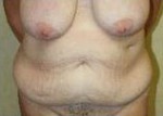 Body Contouring