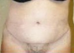 Body Contouring