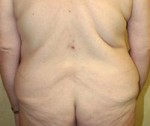 Body Contouring