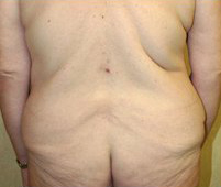 Body Contouring