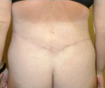 Body Contouring
