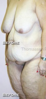 Body Contouring