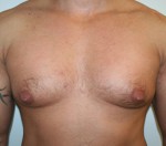 Gynecomastia (Male Breast Reduction Surgery)