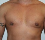 Gynecomastia (Male Breast Reduction Surgery)