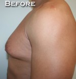 Gynecomastia (Male Breast Reduction Surgery)