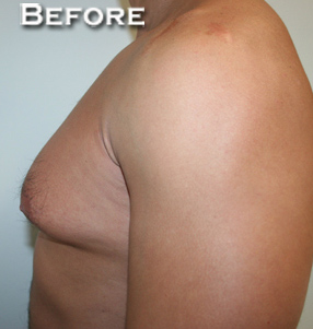 Gynecomastia (Male Breast Reduction Surgery)