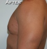 Gynecomastia (Male Breast Reduction Surgery)