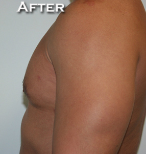 Gynecomastia (Male Breast Reduction Surgery)