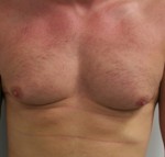 Gynecomastia (Male Breast Reduction Surgery)