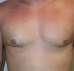 Gynecomastia (Male Breast Reduction Surgery)