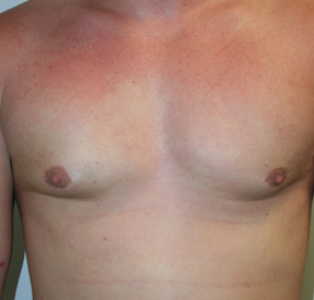 Gynecomastia (Male Breast Reduction Surgery)