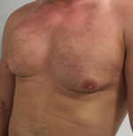 Gynecomastia (Male Breast Reduction Surgery)