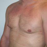 Gynecomastia (Male Breast Reduction Surgery)