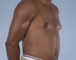 Gynecomastia (Male Breast Reduction Surgery)