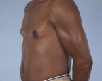 Gynecomastia (Male Breast Reduction Surgery)