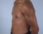 Gynecomastia (Male Breast Reduction Surgery)