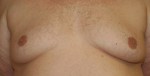 Gynecomastia (Male Breast Reduction Surgery)
