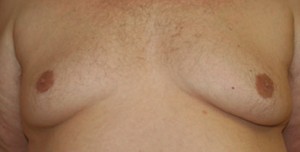 Gynecomastia (Male Breast Reduction Surgery)