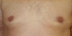 Gynecomastia (Male Breast Reduction Surgery)