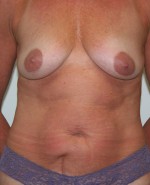 Tummy Tuck (Abdominoplasty)