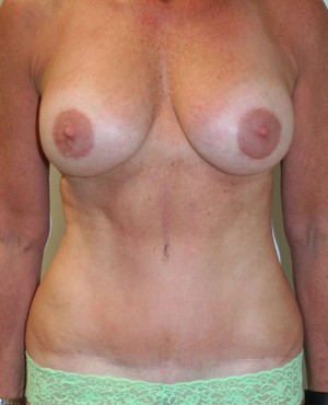 Tummy Tuck (Abdominoplasty)
