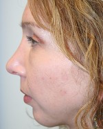 Nose Surgery (Rhinoplasty)