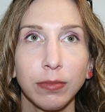Nose Surgery (Rhinoplasty)