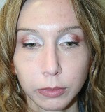 Nose Surgery (Rhinoplasty)
