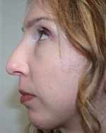 Nose Surgery (Rhinoplasty)