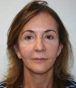 Face Lift