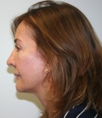 Face Lift