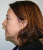 Face Lift