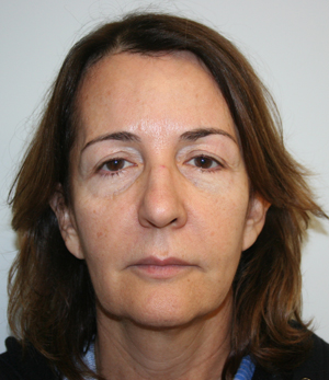 Face Lift