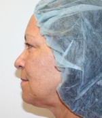 Face Lift
