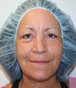 Face Lift
